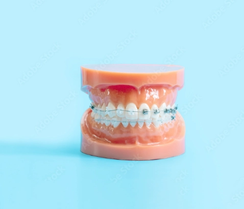 A pair of dental braces.
